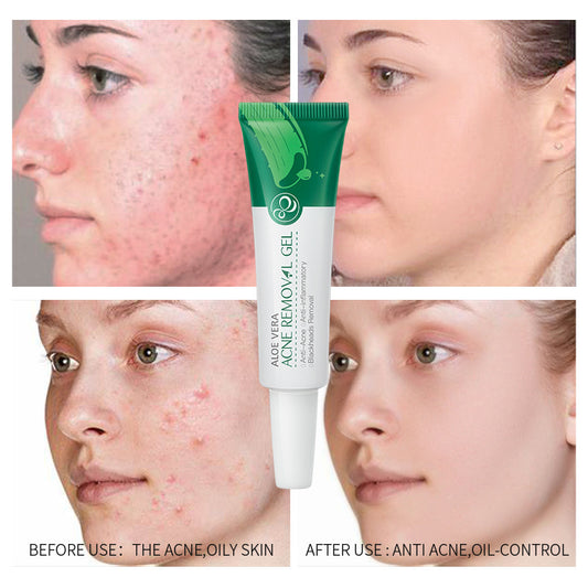 Aloe Vera Anti-Acne Treatment Gel – Soothing Cream Serum, Reduced Pores and Balanced Hydration